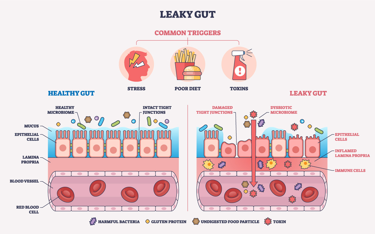 Diagram comparing a healthy gut barrier with intact tight junctions to a leaky gut with damaged tight junctions